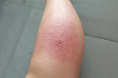 被蜜蜂蛰了怎么处理,要立刻远离蜂巢以免再次被蛰