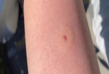 被人头蜂蛰了如何处理，应立即远离蜂巢、再用弱酸性溶液清洗伤口