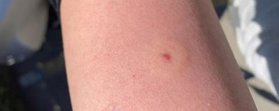 被人头蜂蛰了如何处理，应立即远离蜂巢、再用弱酸性溶液清洗伤口