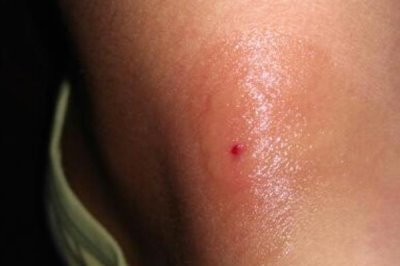 被蜜蜂蛰了怎么处理,要立刻远离蜂巢以免再次被蛰