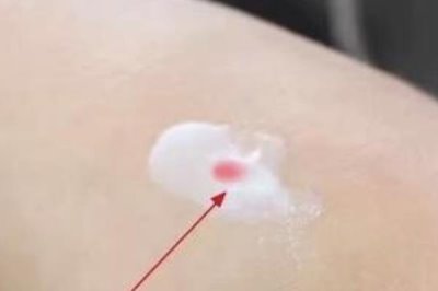 被蜜蜂蛰了怎么处理,要立刻远离蜂巢以免再次被蛰